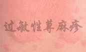 过敏性荨麻疹