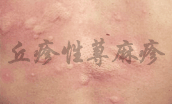 丘疹性荨麻疹