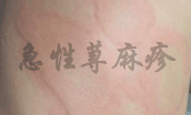急性荨麻疹