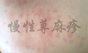 慢性荨麻疹